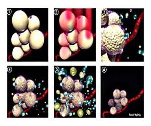lipolasser_funcionamiento